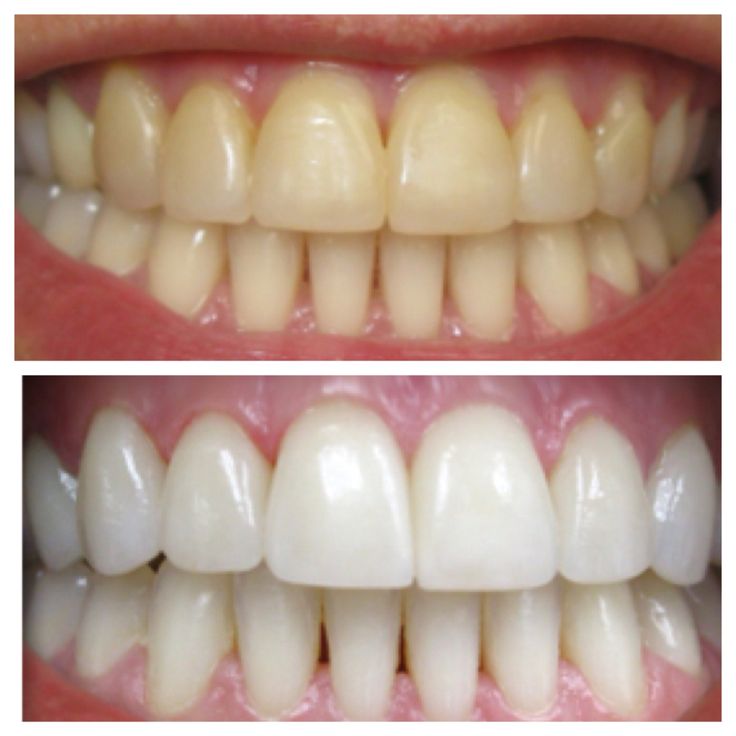 Close-up of a person's bright, white teeth showing the results of professional teeth whitening by SKIN BY JACQUELINE in Scottsdale, AZ.