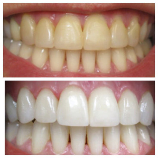 Close-up of a person's bright, white teeth showing the results of professional teeth whitening by SKIN BY JACQUELINE in Scottsdale, AZ.